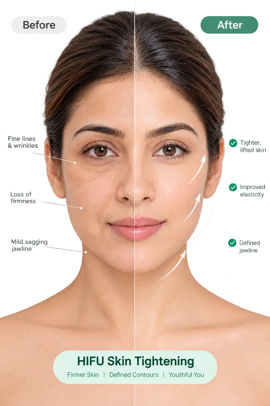 Woman with lifted, firm skin after a HIFU skin tightening treatment