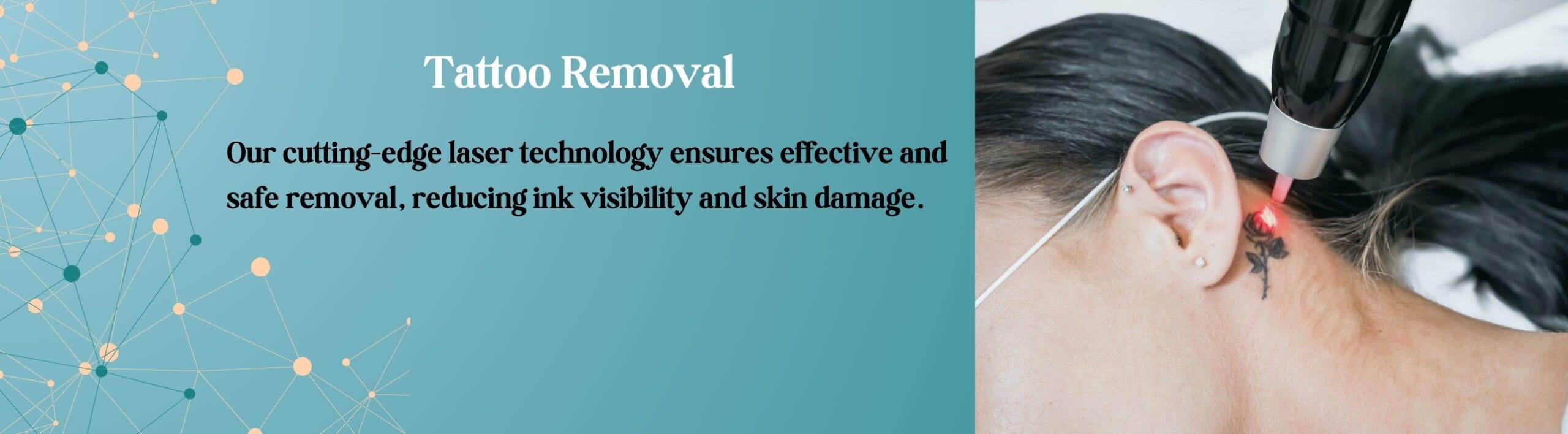 Tattoo Removal treatment