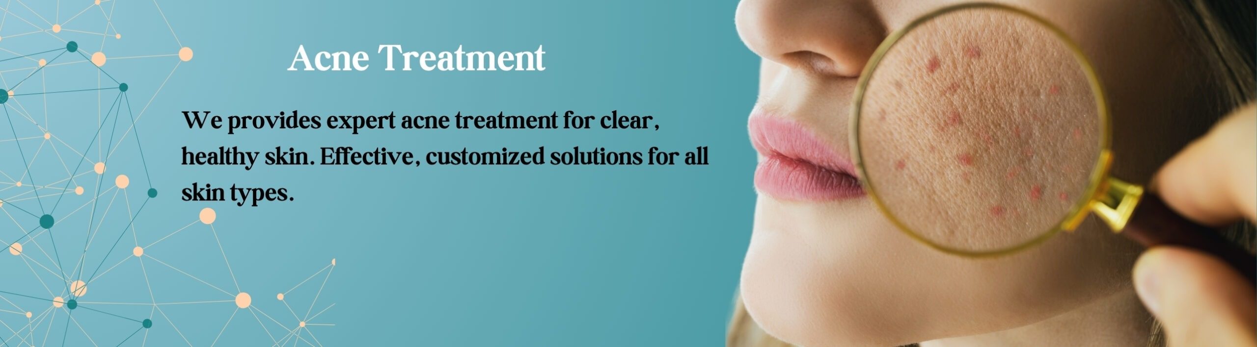 Acne Treatment